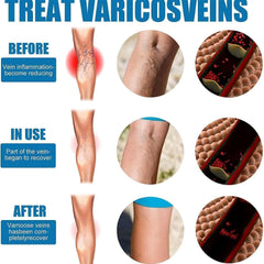 Vein Healing Varicose Veins Treatment Spray Pack of 2