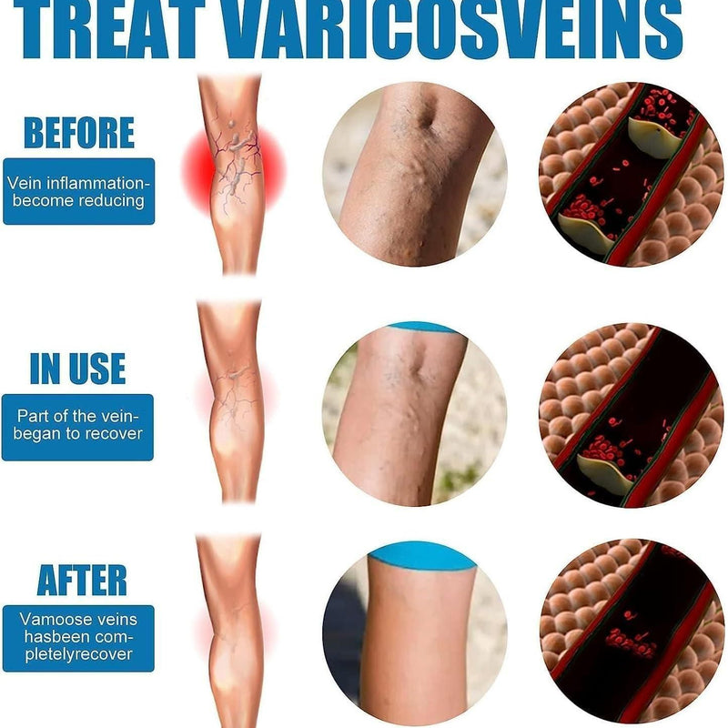 Vein Healing Varicose Veins Treatment Spray Pack of 2